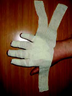 Exemple d’une compression spécifique d’un oedème des doigts et de la main.