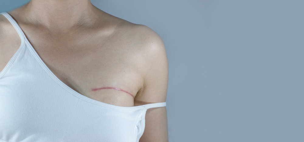 Le tatouage pour reconstruire le mamelon et l’aréole après une mastectomie. Dermopigmentation médicale ou tatouage artistique en 3D, quelles différences et comment choisir l’option la plus adaptée ?