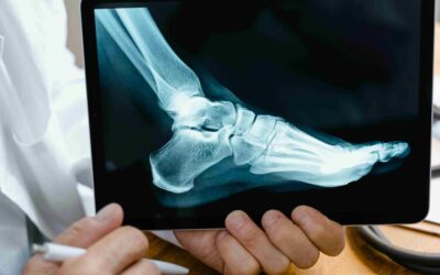 Névrome de Morton : prise en charge en kinésithérapie